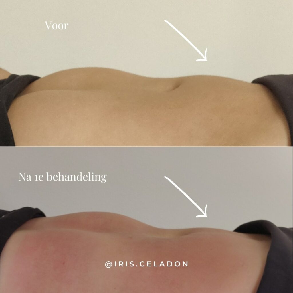@iris.celadon Transformational cupping buikvet before and after