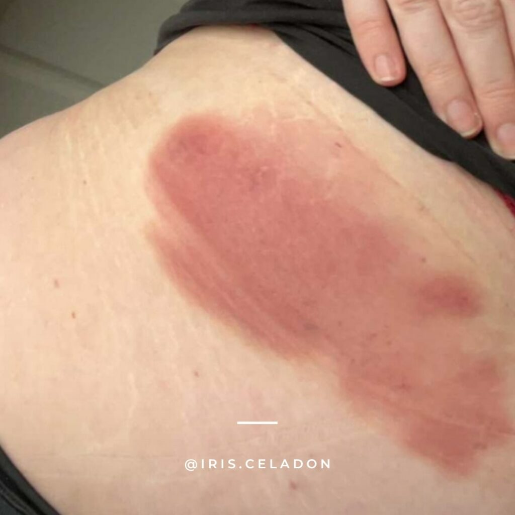 @iris.celadon Transformational cupping heupvetje