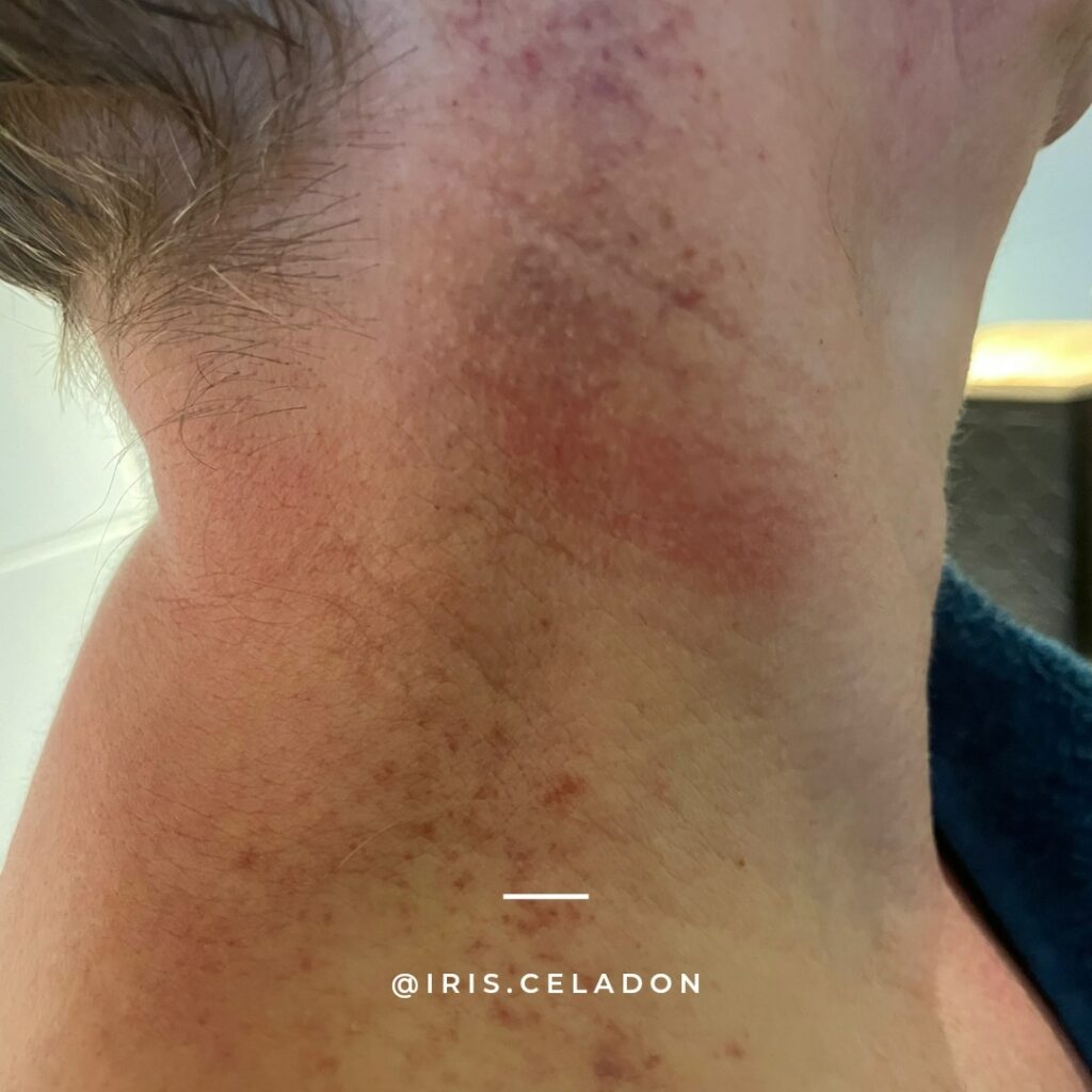 @iris.celadon Transformational cupping nekpijn nekklachten