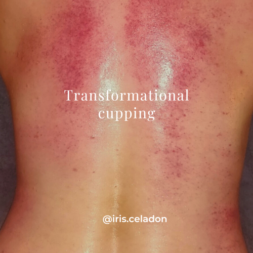 @iris.celadon Transformational cupping rugklachten schouderklachten gespannen nek gespannen schouders